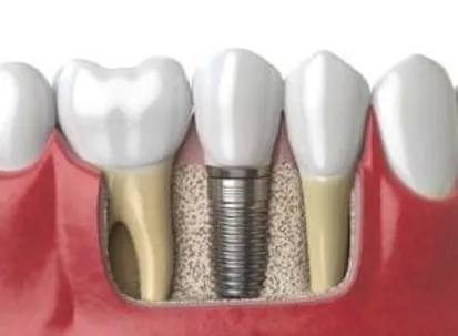 iMPLANT 2 JPG Blue Stone Hills Dentistry