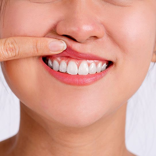 gum recession 2024 543 Blue Stone Hills Dentistry