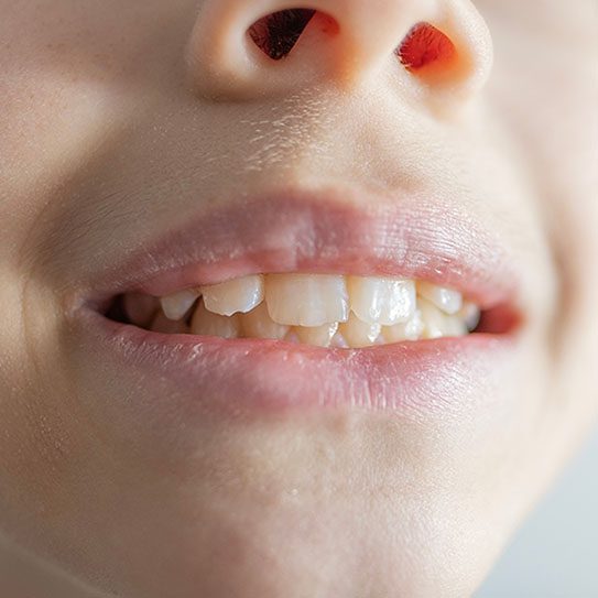 child gum disease 2024 543 Blue Stone Hills Dentistry