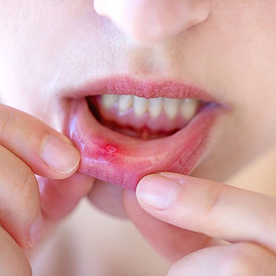 canker sore 2025 543 Blue Stone Hills Dentistry