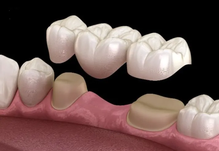 Dental bridge JPG Blue Stone Hills Dentistry dental crowns