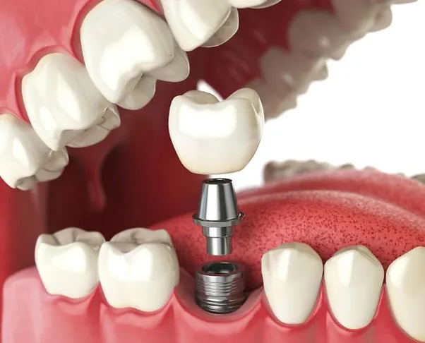 Implant JPG Blue Stone Hills Dentistry