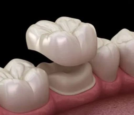 dental crowns