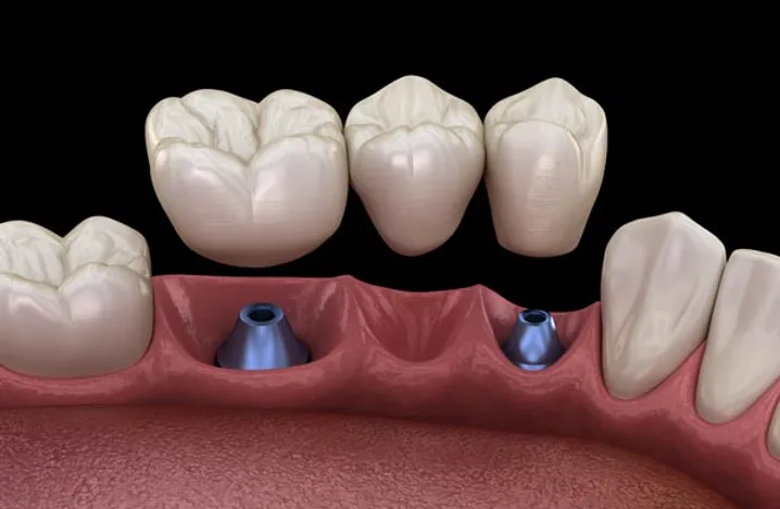 dental implants supported bridges Blue Stone Hills Dentistry dental crowns