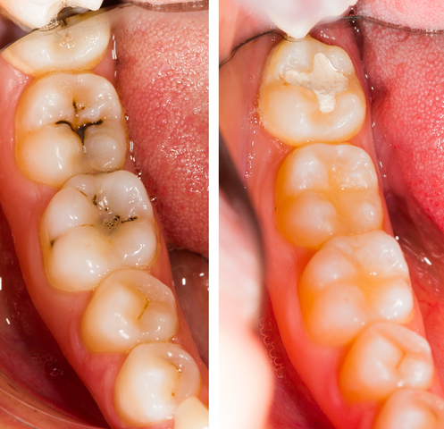 composite fillings in harrisonburg va