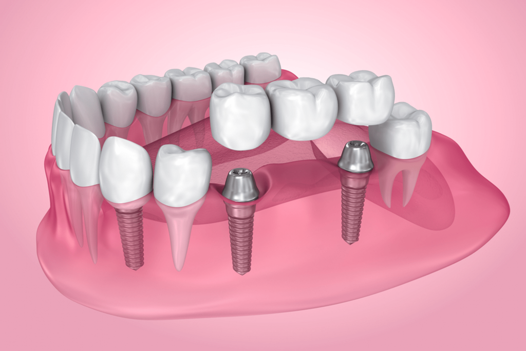 implant bridges in harrisonburg va